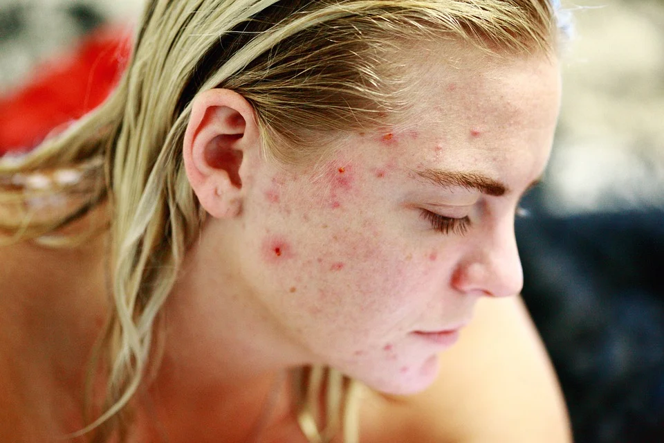 Impact of Food on the Skin: Can it Cause Acne